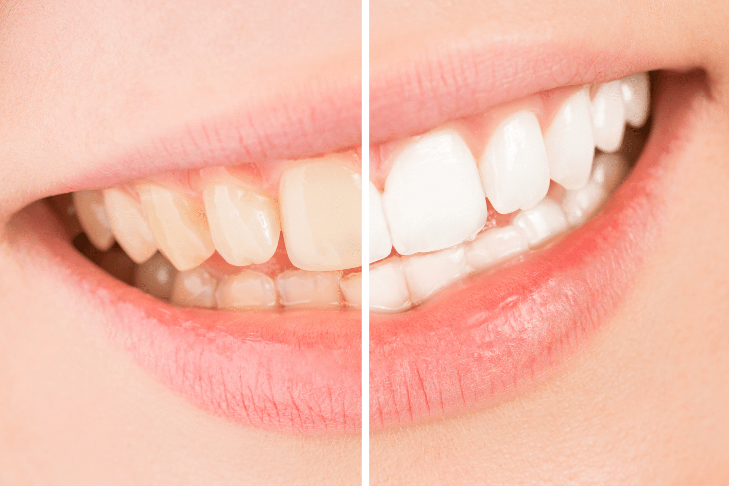 Teeth Whitening