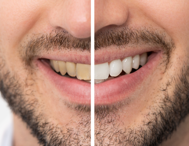 Tooth whitening