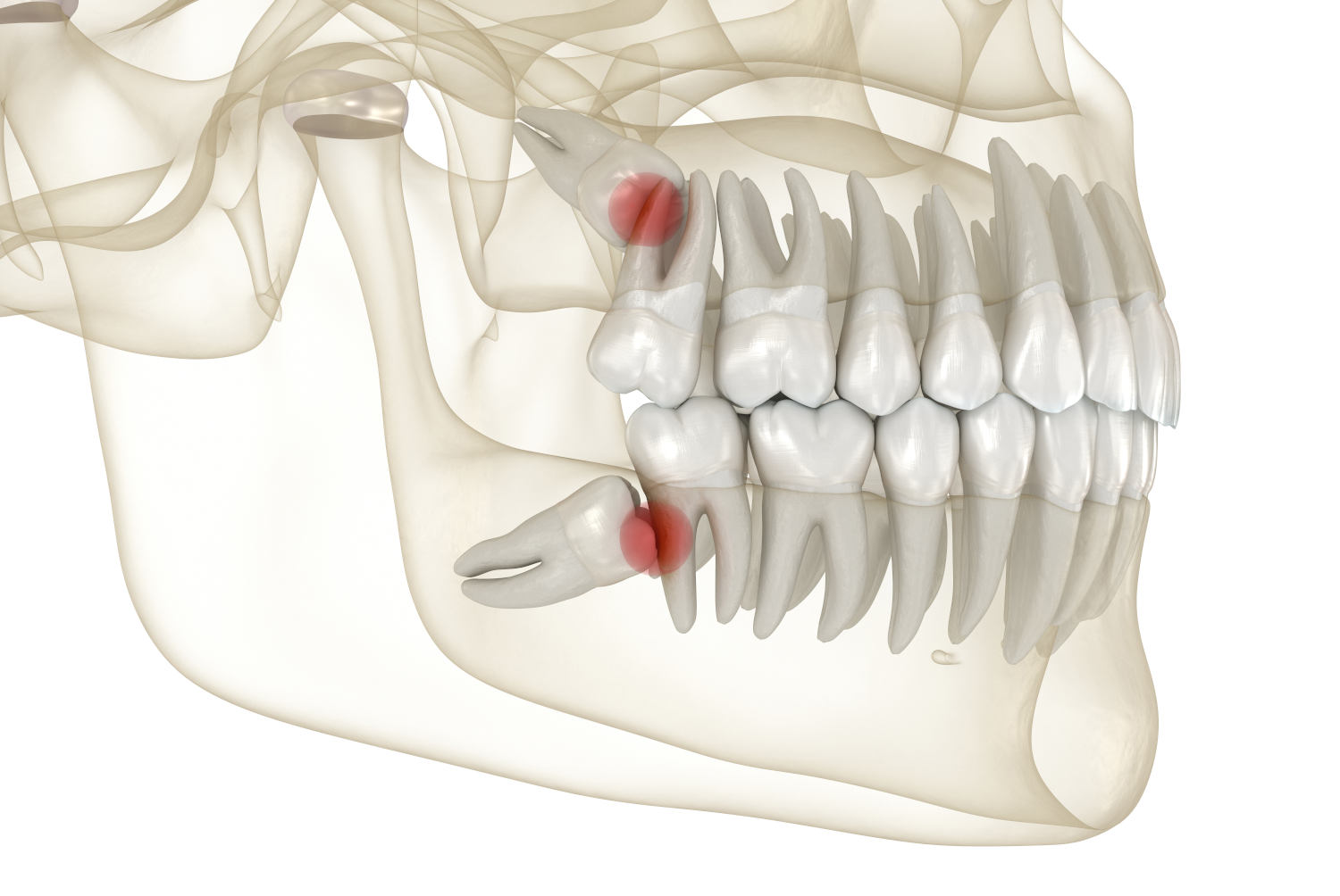wisdom tooth surgical removal